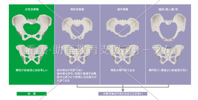 骨盤形状の分類