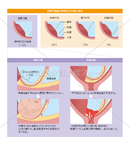 臍帯の胎盤付着部位の分類と頻度