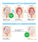 臍帯下垂・臍帯脱出の病態と処置