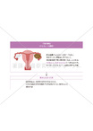 卵巣腫瘍の子宮内膜症との関係