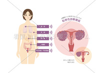 転移性卵巣腫瘍