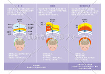 主な分娩時頭部損傷の比較