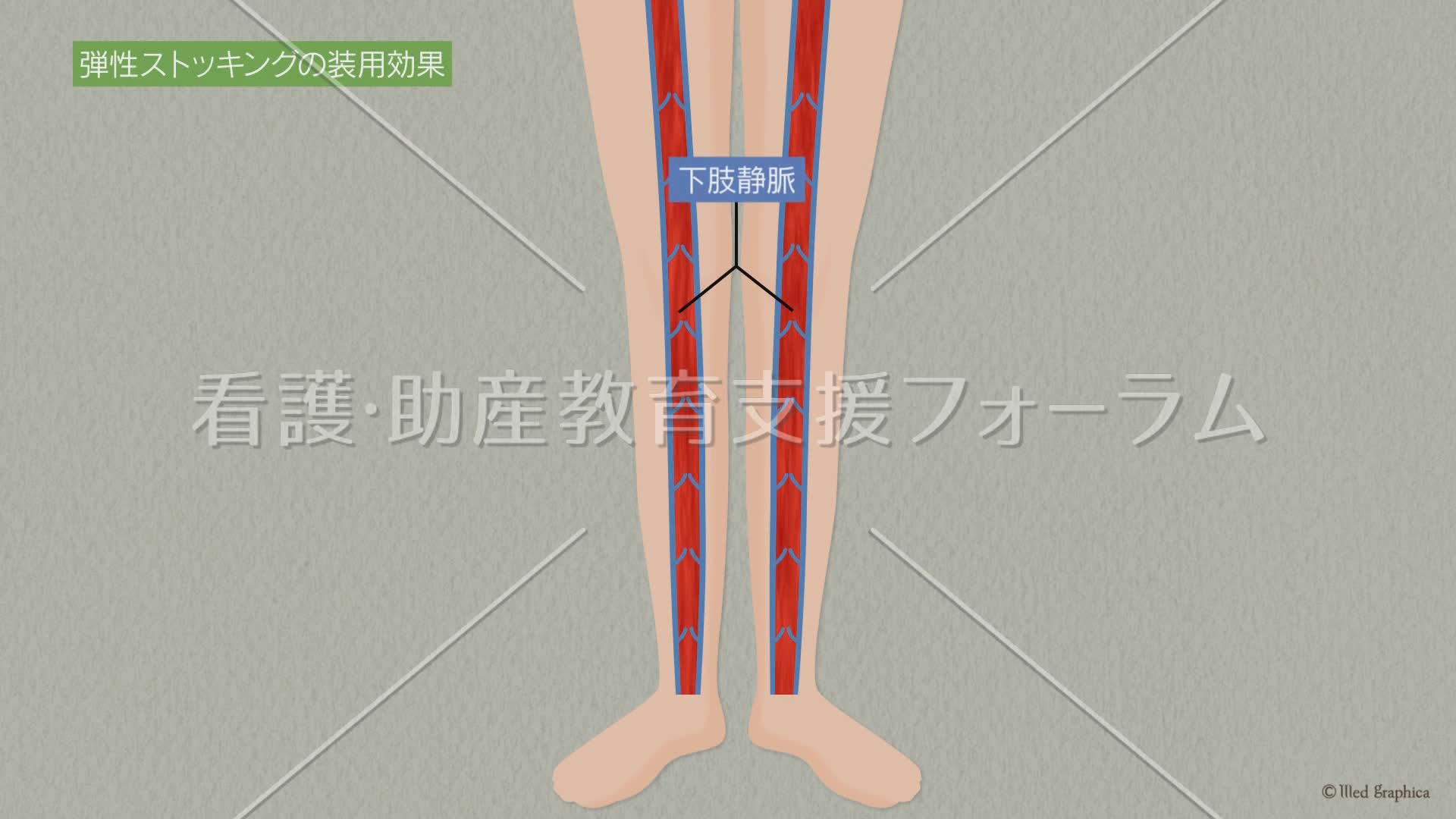 弾性ストッキングの装用効果