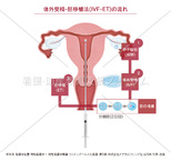 体外受精-胚移植法(IVF-ET)の流れ