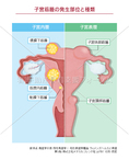 子宮筋腫の発生部位と種類