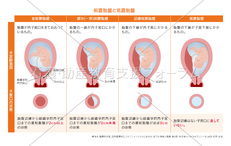 前置胎盤と低置胎盤