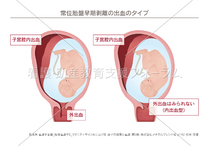 常位胎盤早期剥離の出血のタイプ