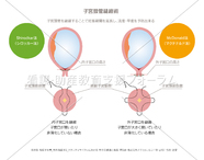 頚管縫縮術