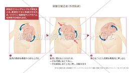 骨盤位矯正術（外回転術）