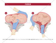 内回転術