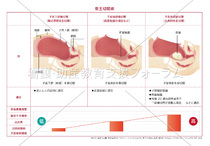 帝王切開術