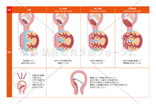 癒着胎盤の分類