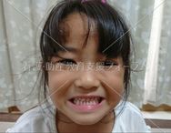 乳歯（5歳児）