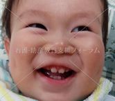 乳歯（11ケ月児）