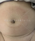 臍ヘルニア　乳児　圧迫療法後の臍部